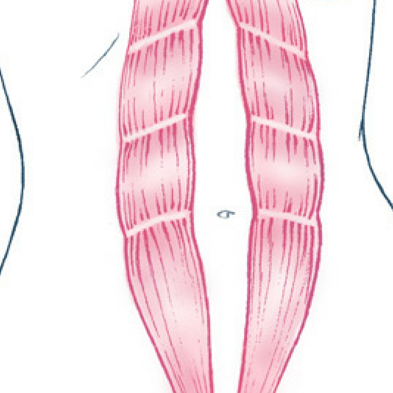 picture of Diastasis Recti