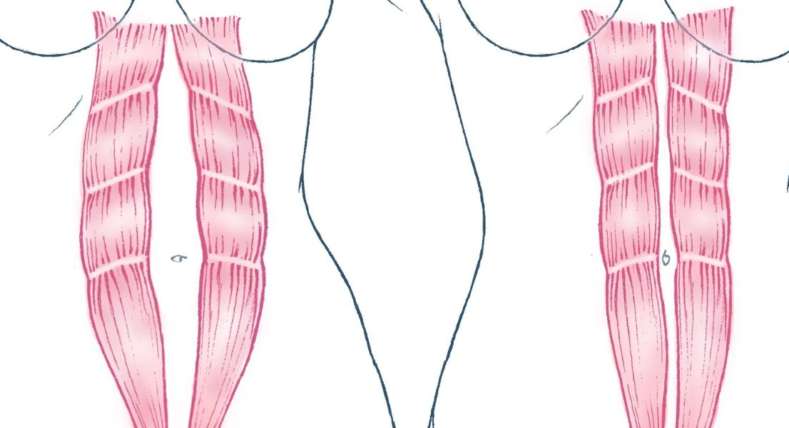 image of diastasis recti test