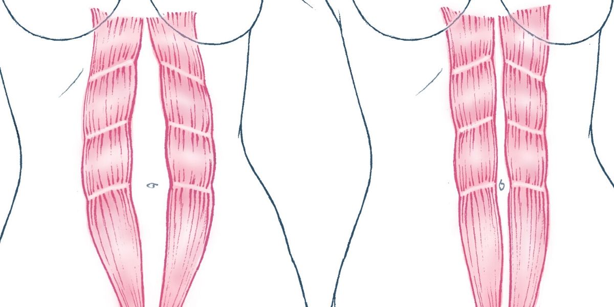 image of diastasis recti test