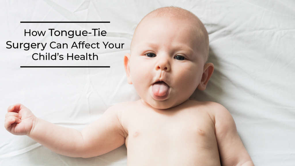 picture of tongue tie surgery